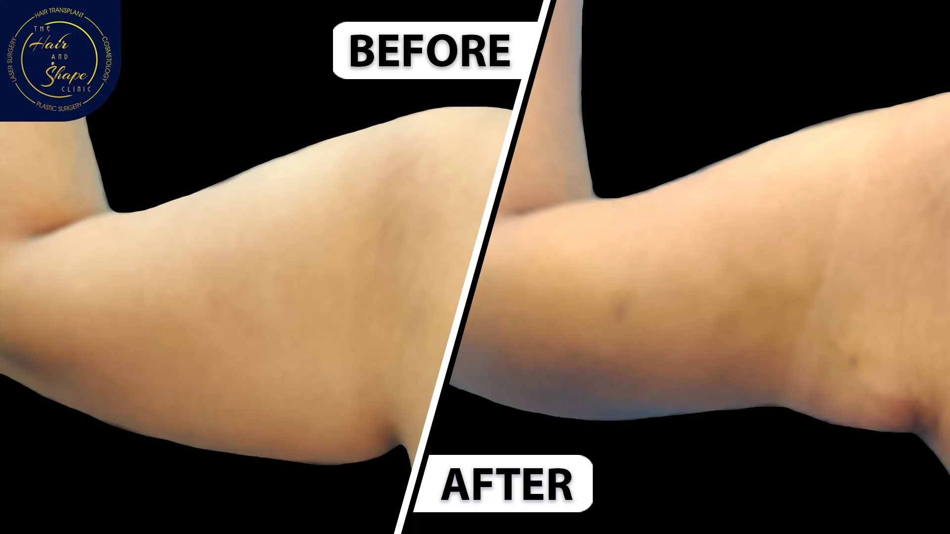 Arm lift result5
